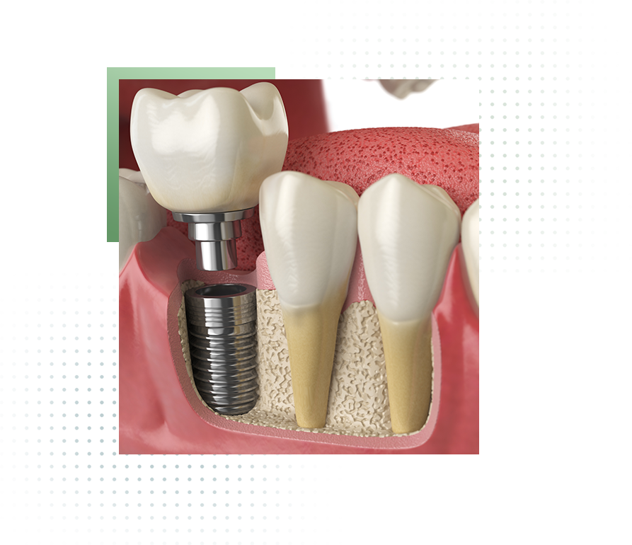 How-Dental-Implant-Works
