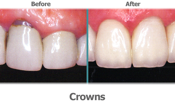before-after-crowns