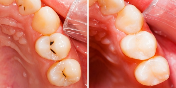 dental-decay-restoration-before-after
